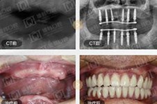 長沙全口種植牙價(jià)格公布，滿口種植牙大概多少錢能做？