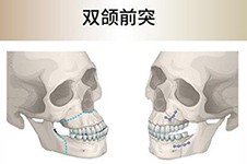 长沙正颌手术哪里比较好,分享可以做正颌手术的正规医院!