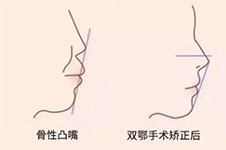 上海凸嘴医院排行前5分享，在上海做突嘴手术哪里好？