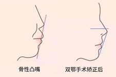 上海凸嘴醫(yī)院排行前5分享，在上海做突嘴手術(shù)哪里好？