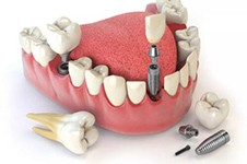 临沂比较出名的牙科有几家,在临沂种牙去哪个医院好?