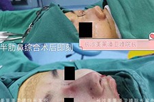 長沙美萊做鼻子真人案例合集,看潘衛(wèi)峰隆鼻即刻無P圖效果!