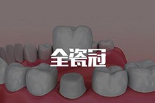 广州全瓷牙哪个牙科医院做得好,价位价格表公布多少钱一颗!
