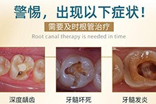 广州根管治疗收费标准公布,揭秘做根管治疗多少钱一颗牙!