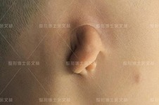 广州耳畸形再造多少钱？价格表分享耳朵畸形整形价格！