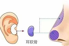 耳软骨隆鼻第二天痛哭了,要痛几天多久恢复注意事项盘点下!