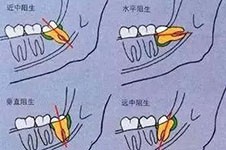 智齿一半在肉里好拔吗？搞懂原因是否阻生很关键！