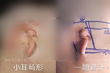 广州余文林做耳朵怎么样?19岁成年做耳再造一二期真实经历!