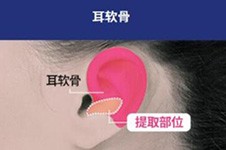 广州耳软骨隆鼻的价钱分享,还附广州耳软骨隆鼻好医院医生!