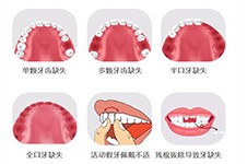 广州种牙哪家医院口碑好?分享5组植牙植牙真实反馈给你看!