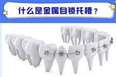 广州箍牙齿一般多少钱?价格表分享一份还包含箍牙好医院!