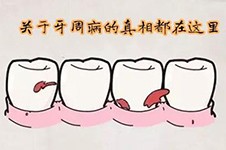 广州牙周病治疗哪家医院好,做牙周炎治疗需要多少钱贵吗?