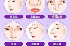 广州隆鼻子大概需要多少钱?不同鼻型&材料做鼻子费用揭秘!