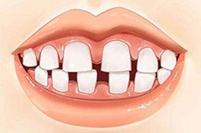 成人牙缝越来越大了怎么办?五种靠谱修复方式看哪个适合你!