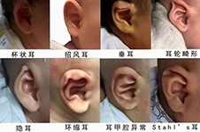 问:广州哪里看耳朵比较好？做耳畸形正规靠谱的医院盘点！