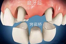 牙齿搭桥需要磨掉多少好牙？听说牙损伤超大是真的吗？