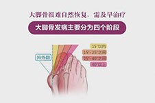 广州拇外翻手术哪家医院好?做正骨拇指外翻手术一般多少钱?