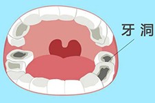 广州补牙一般多少钱一颗？收费标准+补牙好医院合集分享！