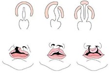 广州唇裂整形好的医院,单双侧唇裂/唇腭裂这家可修复!