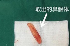 广州鼻修复要10万吗?鼻修复手术一般多少钱?按情况揭秘价格!