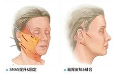 广州做面部提升厉害的医生盘点,抗衰拉皮选这十位技术不错!