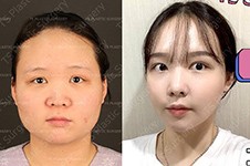 韩国Ts轮廓手术真人照片反馈，综合改善告别平庸形象！