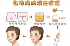 王世虎吸脂與脂肪填充怎么樣？用戶口碑如何能打多少分？