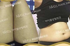 我在韩国爱我整形做过吸脂手术,腰腹大腿抽脂后结果超满意!