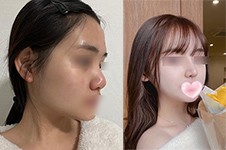 韩国UcanB整形外科拿手项目公开,院内做眼鼻/吸脂/抗衰均不错