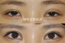 韩国眼修复医院推荐世美整形,多种高难度修复类型都可做!