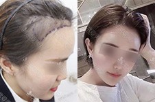 我在北京新生植发医院种植发际线恢复过程+图片分享