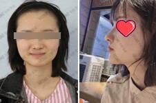 长沙华韩华美做鼻部整形效果如何?公开孙玥玥院长做的鼻子