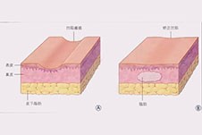 医生说40岁适合全脸脂肪填充，他的话可信度高吗？