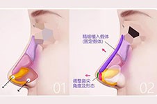 昆明隆鼻的价格一般多少钱合适？肋骨鼻假体鼻费用差不少