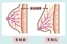 产后胸部干瘪下垂有蔫皮怎么恢复？胸下垂矫正术有人做吗