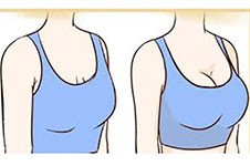 胸下垂怎么能提上去？乳房悬吊术和隆胸哪个好？