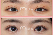 韩国Misoline医院做双眼皮修复怎么样？有没有日记值得看