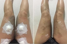 大腿吸脂恢复对比图曝光，韩国这几家医院提供照片案例！