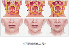 韩国bio朴东满面颈部拉皮术做的好吗 效果好不好案例说了算