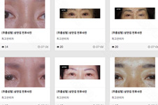 韩国Neo整形朴正日整容案例集合，修复类双眼皮值得一看！