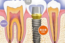 奥齿泰种植体粗度是多少 看奥齿泰种植体各系列特点及用法