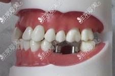 非埋入式种植牙牙冒盖住了什么时候拆掉 拆掉直接装牙冠吗