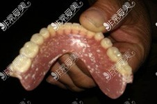 详解bps吸附性义齿是什么材料？对人体是否有害看看就知道
