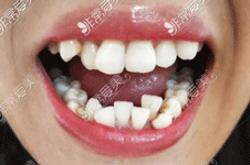 成人戴自锁牙套多久能看到效果 自锁牙套矫正牙齿做人多吗