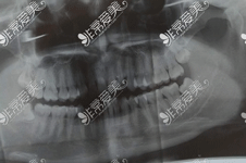 潮州潮安區(qū)牙科醫(yī)院哪里好，潮安靠譜的牙科名單匯總