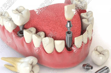 正規(guī)醫(yī)院種植牙收費標準 含國產(chǎn)種植牙 40種進口種植牙價格