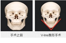 韩国做面部轮廓技术优势有哪些？