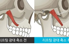 韩国原辰做颧骨整形效果好不好？