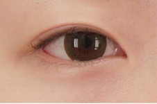 韩国BK外科肿眼泡做成双眼皮效果自然吗？