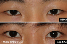韩国的双眼皮为什么这么好看 爱护整形外科做双眼皮太美了